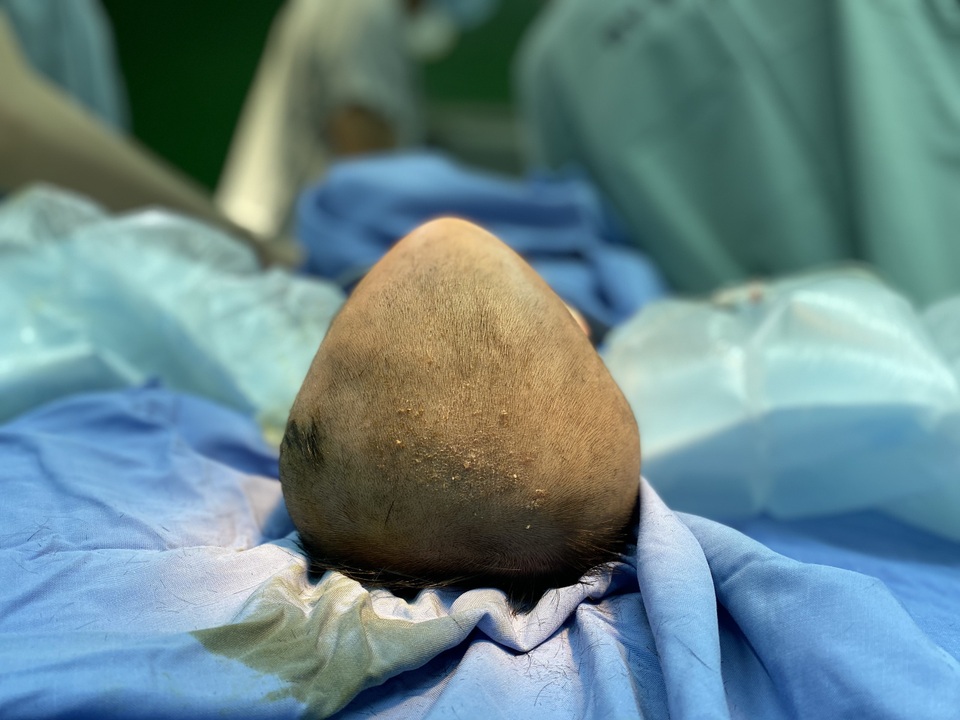 Kỳ lạ bệnh nhi đầu hình tam giác bẩm sinh hiếm gặp - 1