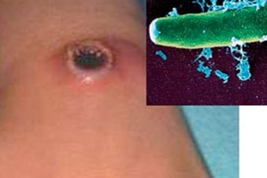 Ăn thịt gia súc chết, 9 người mắc phải bệnh than