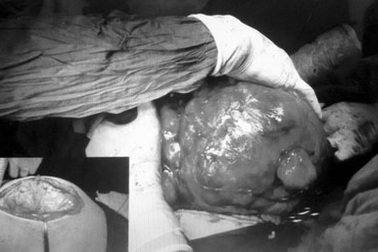 Hai mày râu mang u khủng trong bụng