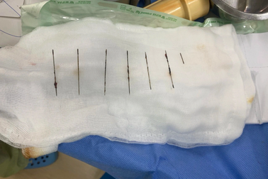 Bệnh nhân tự đâm 7 cây kim may vào lồng ngực