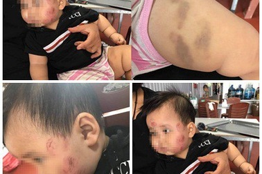 Bé 12 tháng thâm tím khắp người: Nhóm trẻ hoạt động “chui”