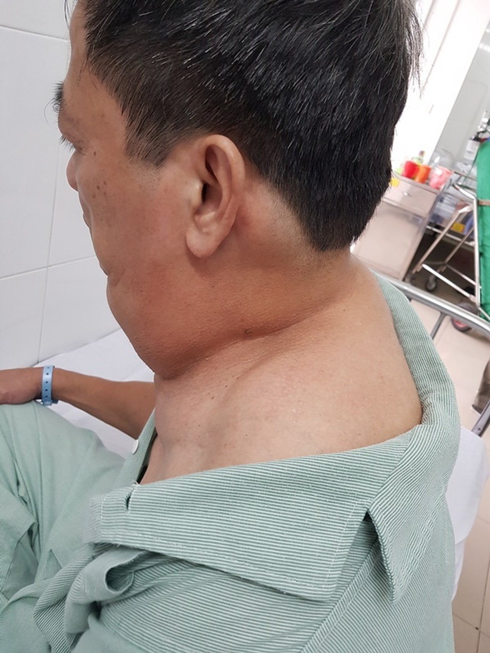 Uống 1 lít rượu mỗi ngày, người đàn ông phát hoảng vì chiếc cổ kỳ dị - 2 Uống 1 lít rượu mỗi ngày, người đàn ông phát hoảng vì chiếc cổ kỳ dị - 2