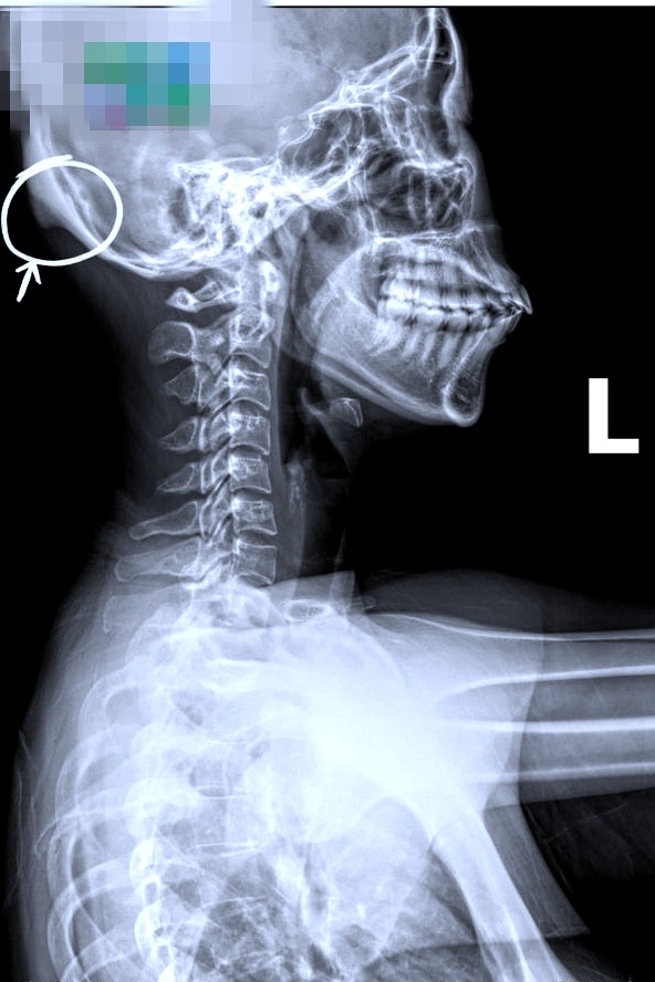 Người phụ nữ ở TPHCM mắc bệnh mọc đuôi ở sọ vì cầm smartphone sai cách - 1