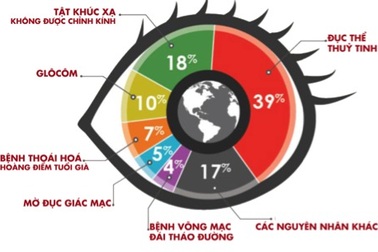 Glôcôm căn bệnh nguy hiểm gây mù lòa
