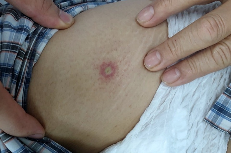 Suýt mất mạng chỉ vì một vết đốt côn trùng - 1