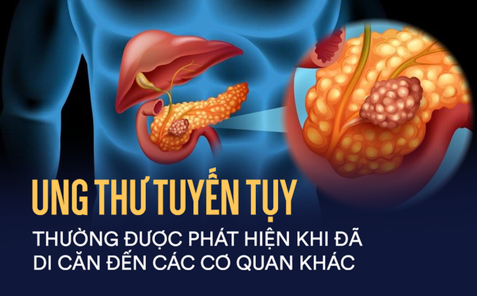 Ung thư tụy là gì? - 1 Ung thư tụy là gì? - 1