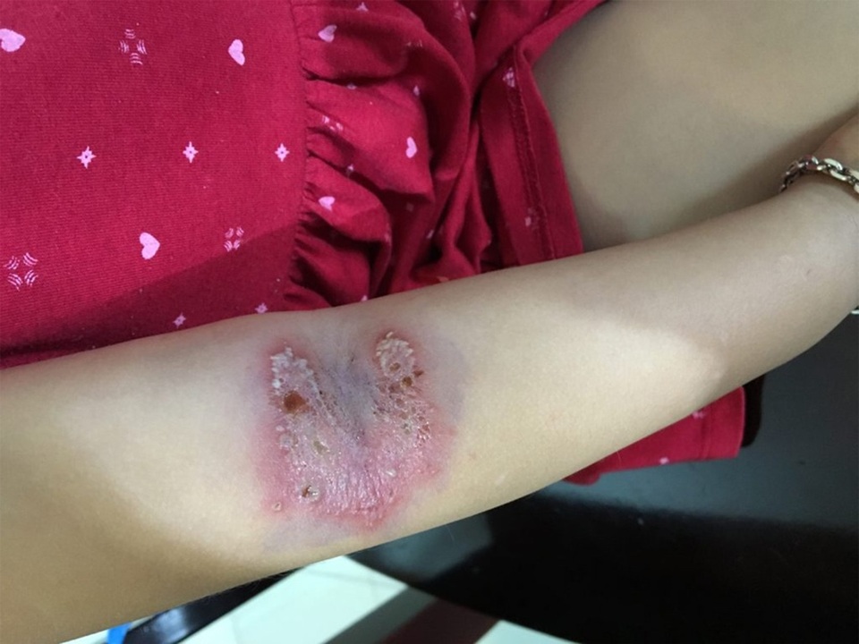 Cách xử lý vết thương do kiến ba khoang gây ra hiệu quả - 3 Cách xử lý vết thương do kiến ba khoang gây ra hiệu quả - 3