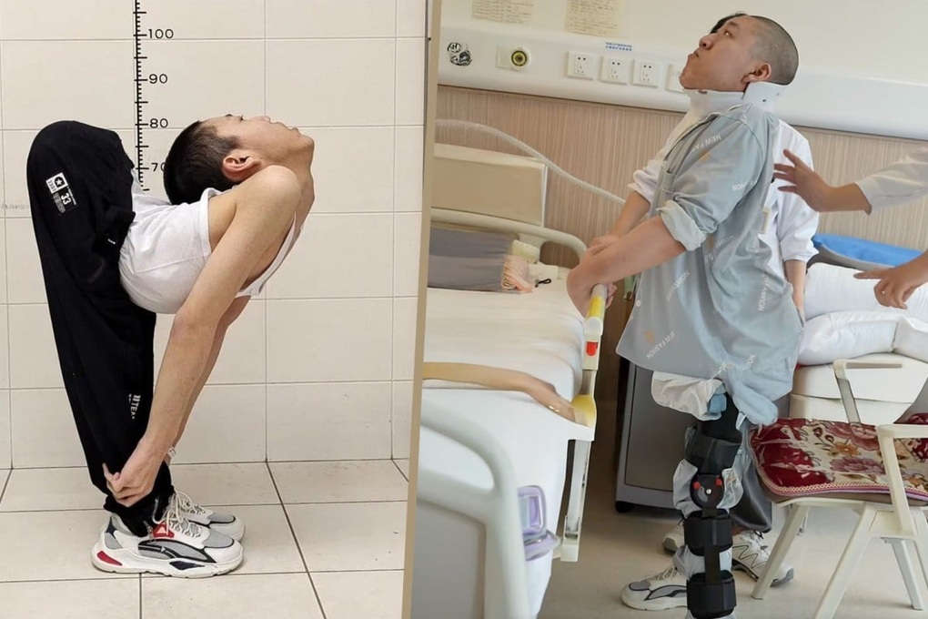 Bước ngoặt của nam sinh bị biến dạng cột sống nặng nề - 1 Bước ngoặt của nam sinh bị biến dạng cột sống nặng nề - 1