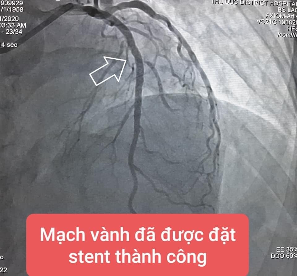 Tự dừng thuốc vì sợ khám dính Covid-19, bệnh nhân suýt chết vì đau ngực - 3 Tự dừng thuốc vì sợ khám dính Covid-19, bệnh nhân suýt chết vì đau ngực - 3