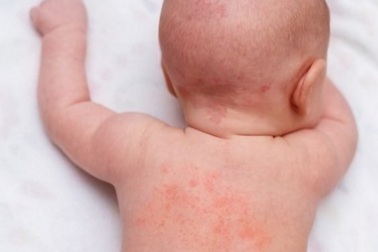 Không lo rôm sảy, mẩn ngứa nhờ Kem Em Bé "4 trong 1"