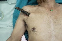 Đi xe đạp bị ngã, cụ ông bị cây gỗ dài 30cm đâm xuyên phổi