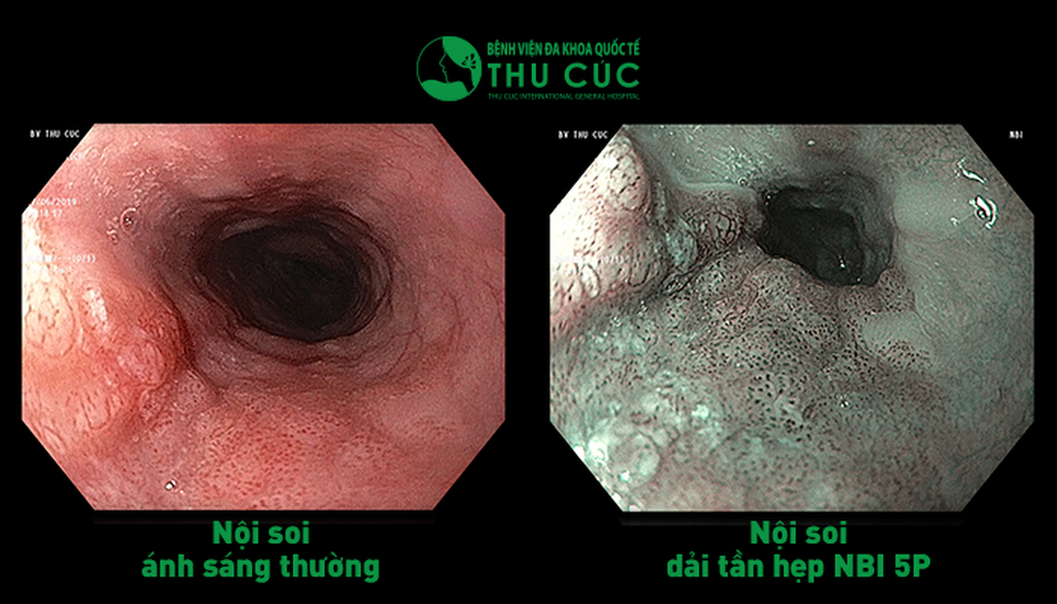 38 tuổi phát hiện ung thư thực quản dù không có triệu chứng gì - 3 38 tuổi phát hiện ung thư thực quản dù không có triệu chứng gì - 3