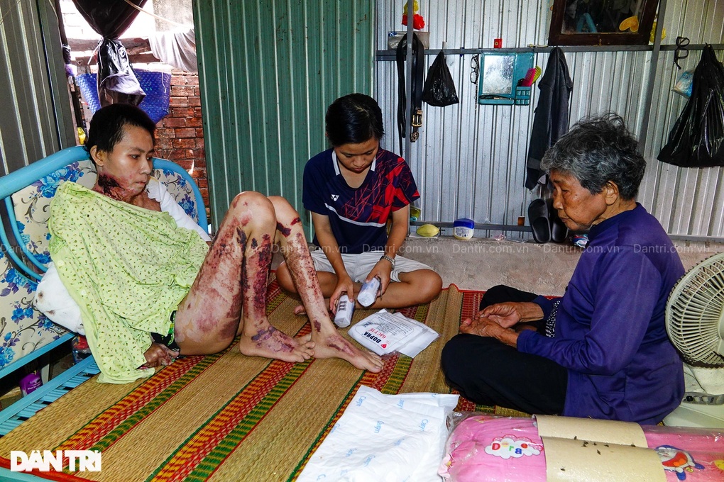 Lời cầu khẩn xin được ghép da của thiếu nữ Hậu Giang bị bạn trai thiêu sống - 1 Lời cầu khẩn xin được ghép da của thiếu nữ Hậu Giang bị bạn trai thiêu sống - 1