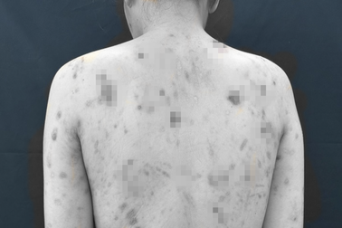 TPHCM: Người phụ nữ 30 tuổi loét khắp cơ thể vì... bệnh thần kinh