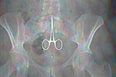 Sống với cây kéo mổ bị quên trong bụng suốt 5 tháng