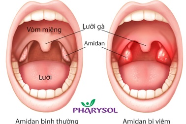 8 bước phòng viêm amidan không cần cắt