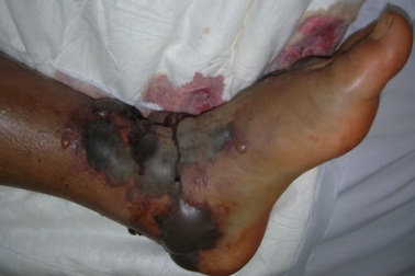 Đắp lá thuốc trị rắn cắn bệnh nhân bị rối loạn đông máu