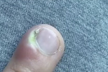 Cô gái 18 tuổi suýt phải cắt cụt ngón tay vì thói quen nhiều người mắc phải