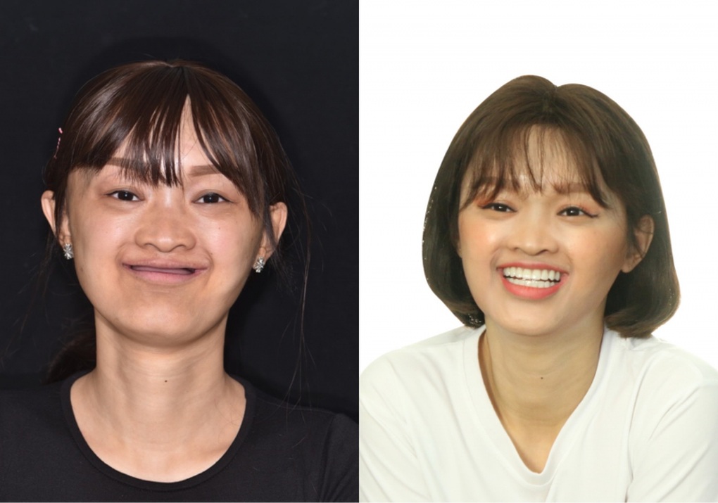 Nụ cười thay đổi số phận của cô gái 27 năm không răng - 1 Nụ cười thay đổi số phận của cô gái 27 năm không răng - 1
