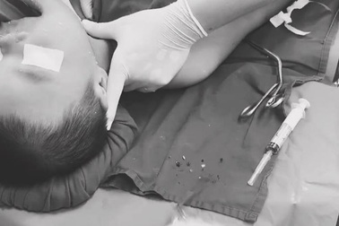 Bé 11 tháng tuổi tử vong vì hóc thạch