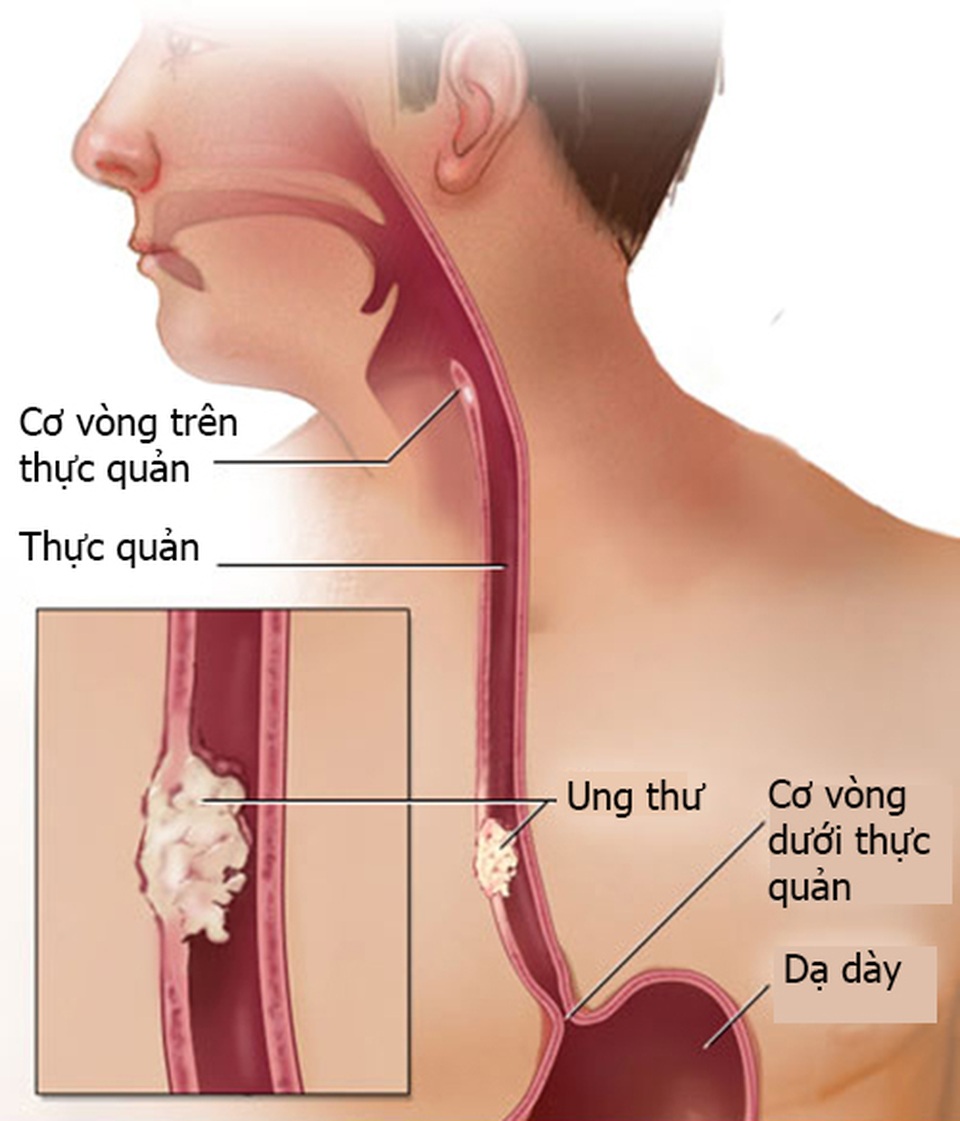 Các giai đoạn của ung thư thanh quản - 1 Các giai đoạn của ung thư thanh quản - 1