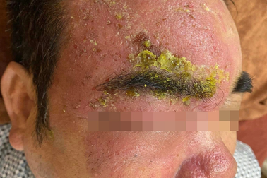 Mắt tổn thương nặng vì đắp đậu xanh chữa zona thần kinh