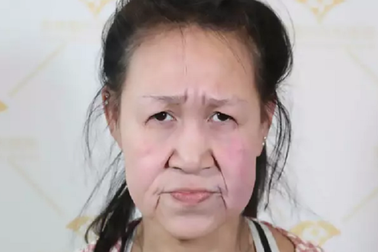 Cô bé 15 tuổi có khuôn mặt bà già lột xác sau phẫu thuật