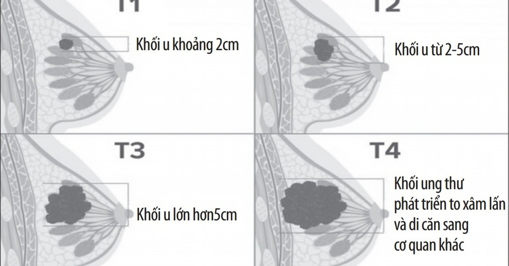 Khối u ở vú, khi nào là ung thư? - 1 Khối u ở vú, khi nào là ung thư? - 1