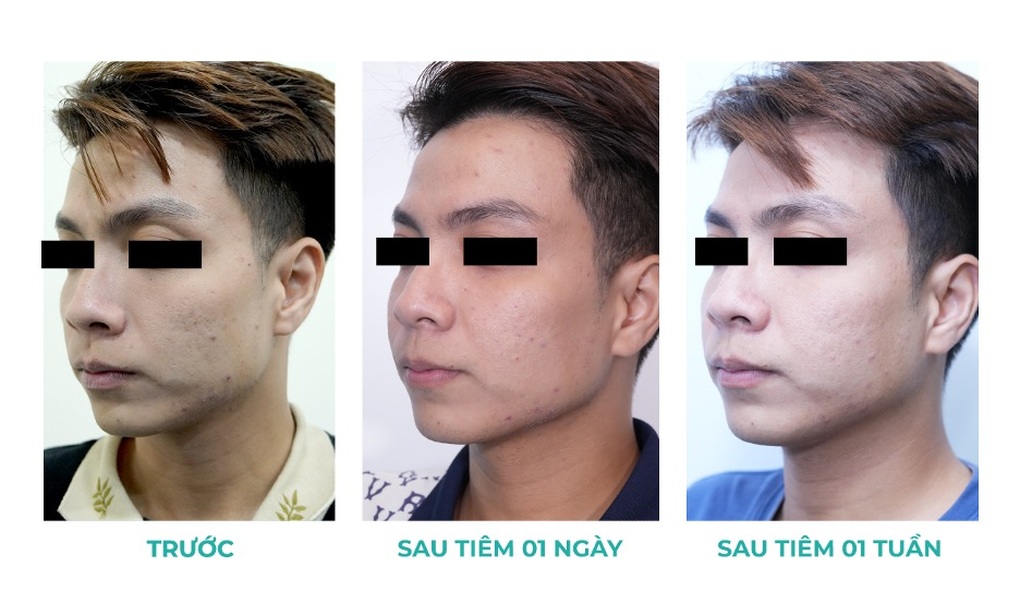 Hội nghị khoa học ứng dụng Belotero Revive trong thẩm mỹ da - 4 Hội nghị khoa học ứng dụng Belotero Revive trong thẩm mỹ da - 4