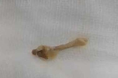 Đọc truyện cười khi ăn, bị xương gà đóng ngang thực quản