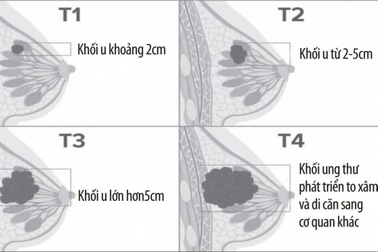 Khối u ở vú, khi nào là ung thư?