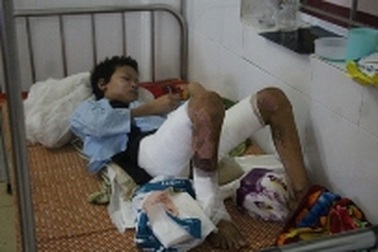 Vụ mẹ đẩy con vào đống lửa: Cháu bé bị bỏng trên 40%
