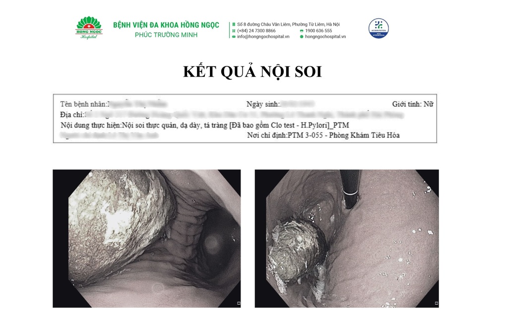 Đau bụng quằn quại vì khối bã thức ăn 15cm chèn ép, gây loét dạ dày - 1