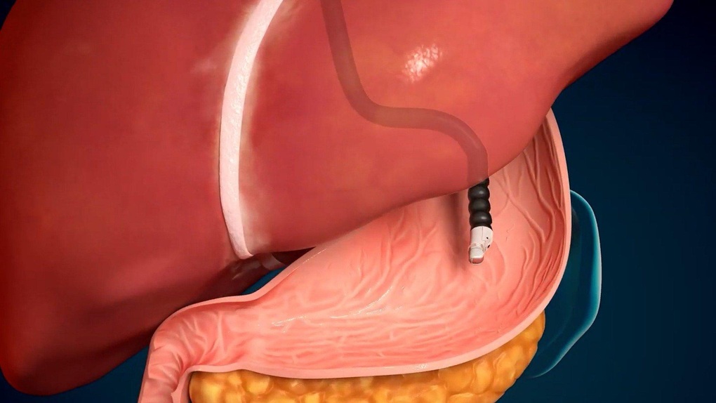 EUS - Bước tiến mới trong tầm soát và hỗ trợ điều trị bệnh lý tiêu hóa - 1 EUS - Bước tiến mới trong tầm soát và hỗ trợ điều trị bệnh lý tiêu hóa - 1
