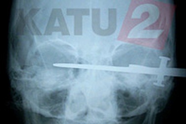 Dao xuyên qua đầu vẫn như không