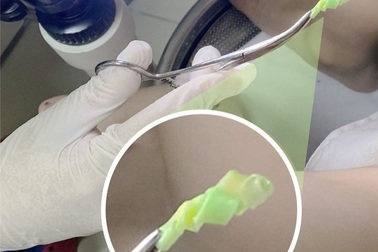 Hy hữu: Dây buộc tóc "kẹt" trong vùng kín bé gái 4 tuổi nhiều tháng liền