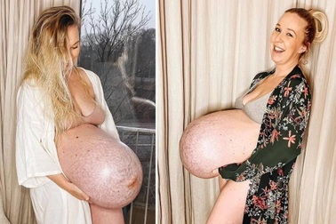 Bụng bầu của người phụ nữ sinh 3 gây sửng sốt trên mạng xã hội