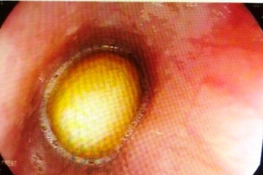 Bé trai gần 2 tuổi bị hạt mít chắn ngang thực quản