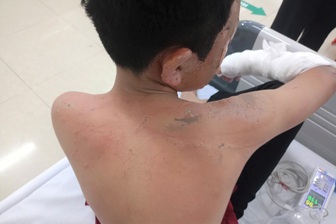 Tự đốt pháo, bé trai 12 tuổi bị bỏng nặng khắp người