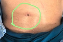 Người đàn ông ở Hòa Bình bị suy đa tạng vì bị mò đốt