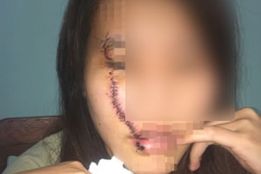 Cô gái bị rạch mặt khi uống nước mía bên đường