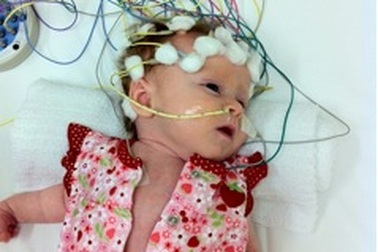 Động kinh - Nguy cơ cao sau chấn thương sọ não