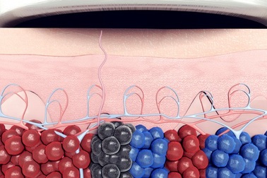 PicoWay - Pico Laser  Công nghệ đỉnh cao trong điều trị da thẩm mỹ và xóa hình xăm 2016