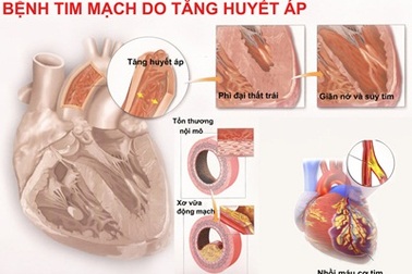 Những nguy cơ do hội chứng chuyển hóa