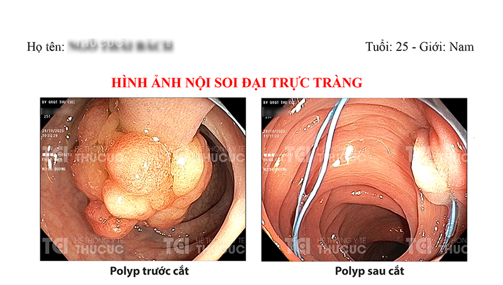 Chàng trai 25 tuổi ôm quả bom nổ chậm 4cm trong lòng đại tràng - 1 Chàng trai 25 tuổi ôm quả bom nổ chậm 4cm trong lòng đại tràng - 1
