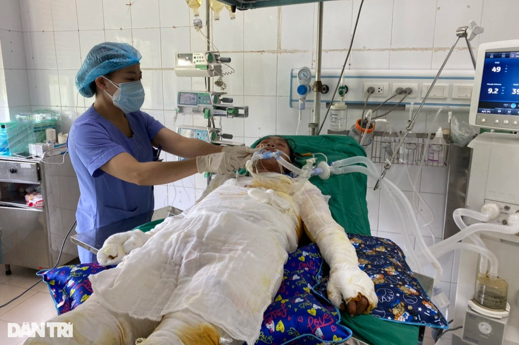 Xót xa hoàn cảnh người bố 4 con bị bỏng 85% cơ thể - 1 Xót xa hoàn cảnh người bố 4 con bị bỏng 85% cơ thể - 1