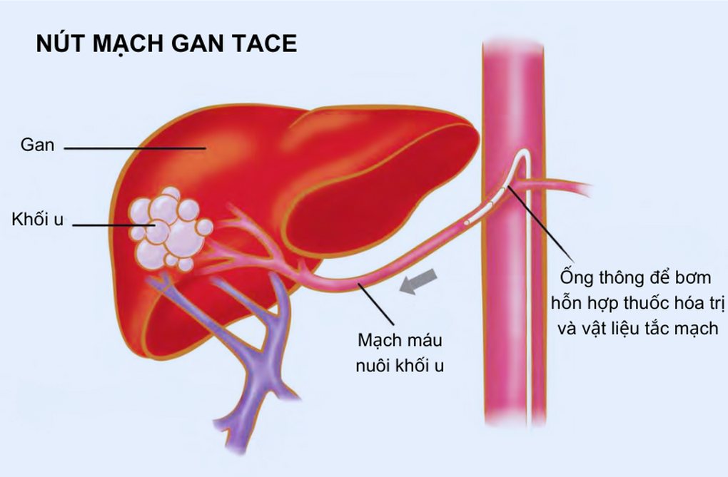 Điều trị ung thư gan bằng phương pháp can thiệp nội mạch cho cụ ông U90 - 1 Điều trị ung thư gan bằng phương pháp can thiệp nội mạch cho cụ ông U90 - 1