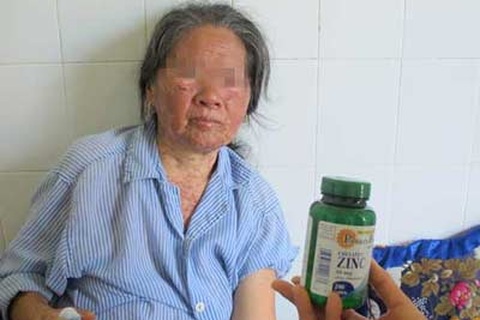 Dị ứng nặng vì dùng thực phẩm chức năng