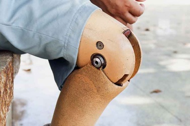 Người ăn xin giấu 240 triệu đồng trong chiếc chân giả