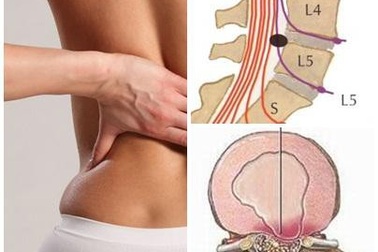 Nguy cơ liệt nửa người nếu coi thường thoát vị đĩa đệm cột sống thắt lưng L5 - S1